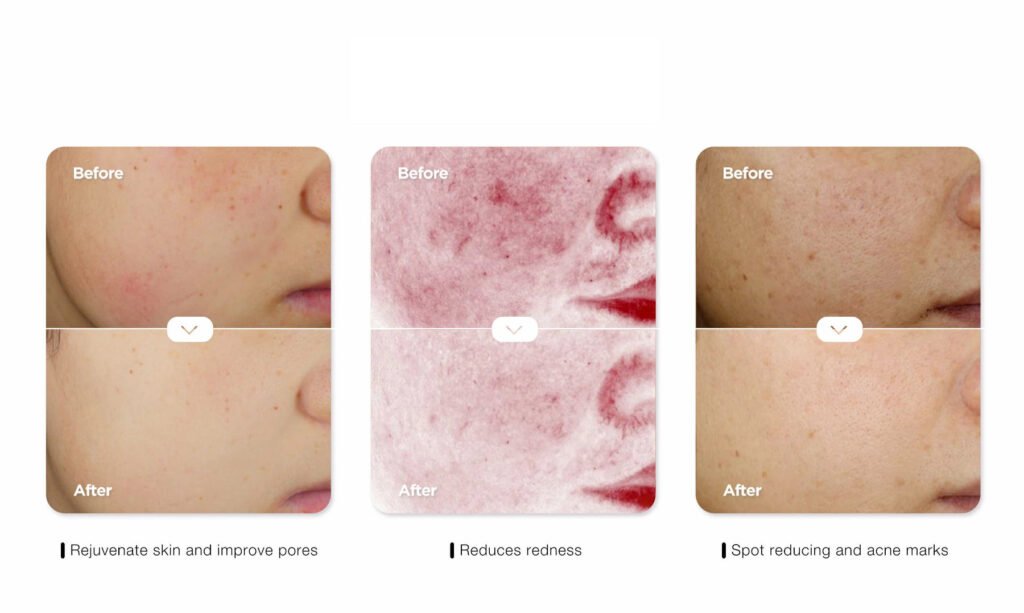 blacken pro dpl photofacial skincare device